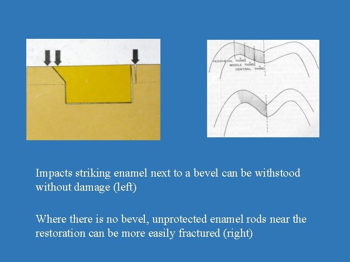 Impacts striking enamel next to a bevel can be withstood without damage (left) Where