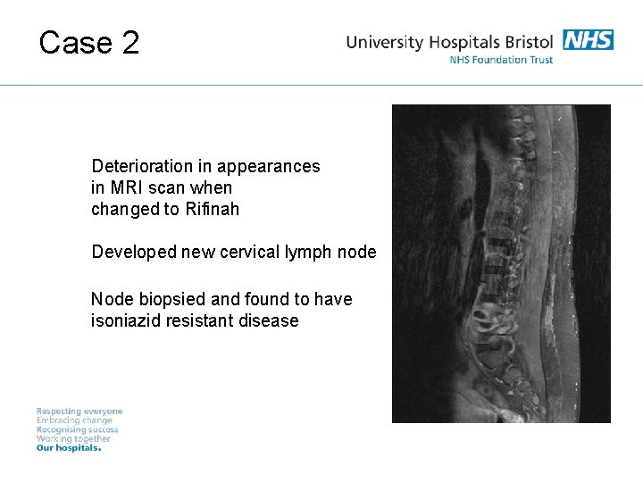 Case 2 Deterioration in appearances in MRI scan when changed to Rifinah Developed new