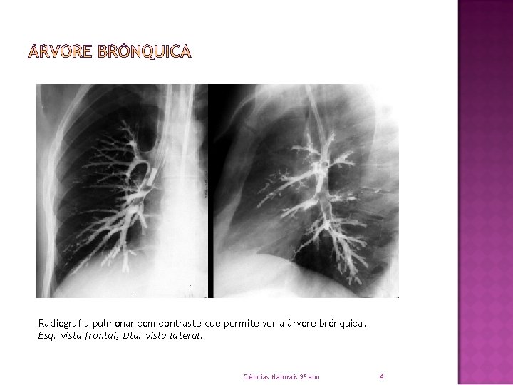Radiografia pulmonar com contraste que permite ver a árvore brônquica. Esq. vista frontal, Dta.