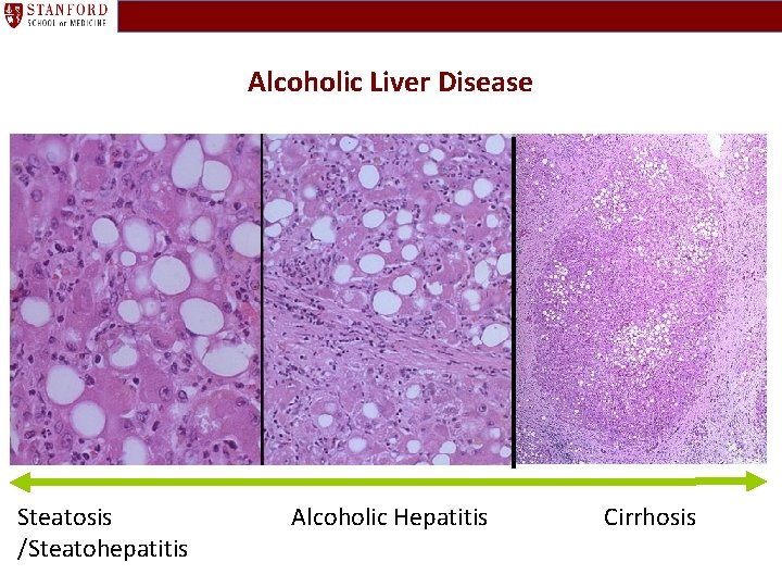 Alcoholic Liver Disease Steatosis /Steatohepatitis Alcoholic Hepatitis Cirrhosis 