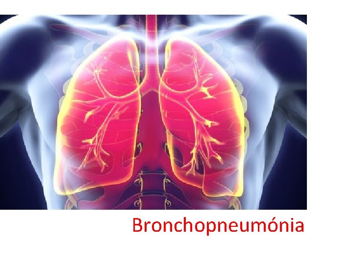 Bronchopneumónia 