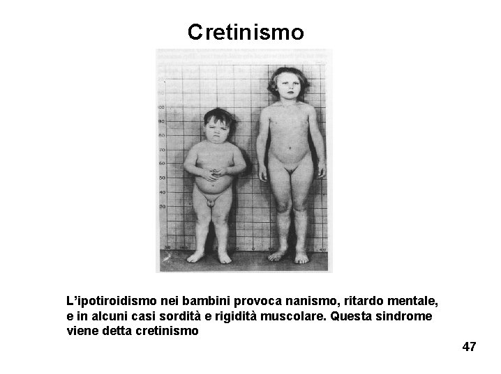 Cretinismo L’ipotiroidismo nei bambini provoca nanismo, ritardo mentale, e in alcuni casi sordità e