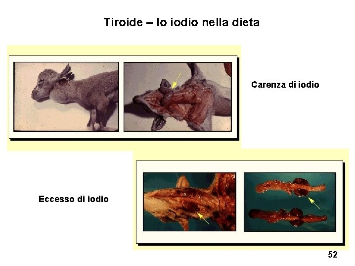 Tiroide – lo iodio nella dieta Carenza di iodio Eccesso di iodio 52 