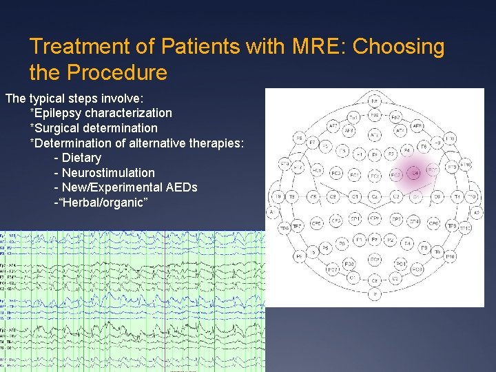 Treatment of Patients with MRE: Choosing the Procedure The typical steps involve: *Epilepsy characterization