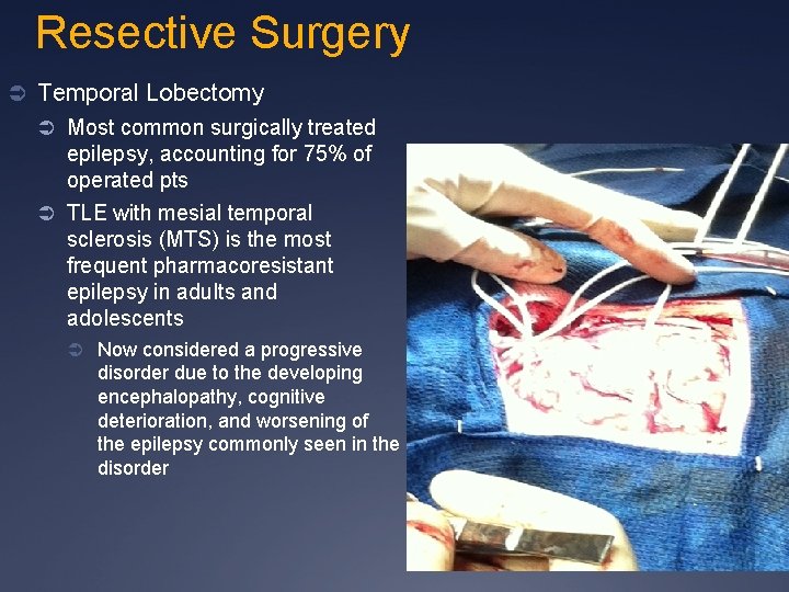 Resective Surgery Ü Temporal Lobectomy Ü Most common surgically treated epilepsy, accounting for 75%