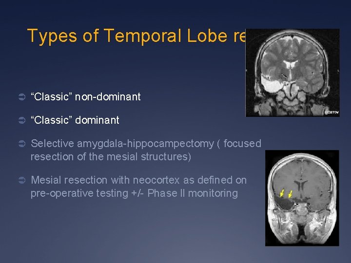 Types of Temporal Lobe resection Ü “Classic” non-dominant Ü “Classic” dominant Ü Selective amygdala-hippocampectomy