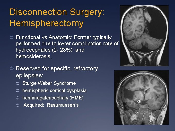 Disconnection Surgery: Hemispherectomy Ü Functional vs Anatomic: Former typically performed due to lower complication
