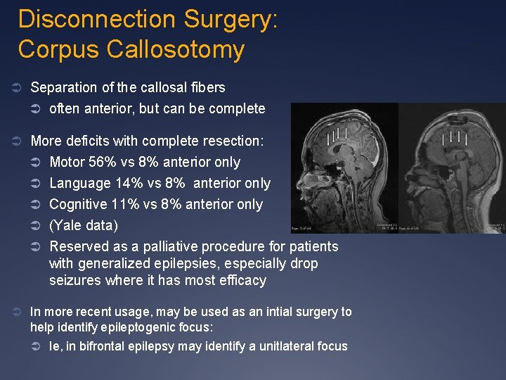 Disconnection Surgery: Corpus Callosotomy Ü Separation of the callosal fibers Ü often anterior, but