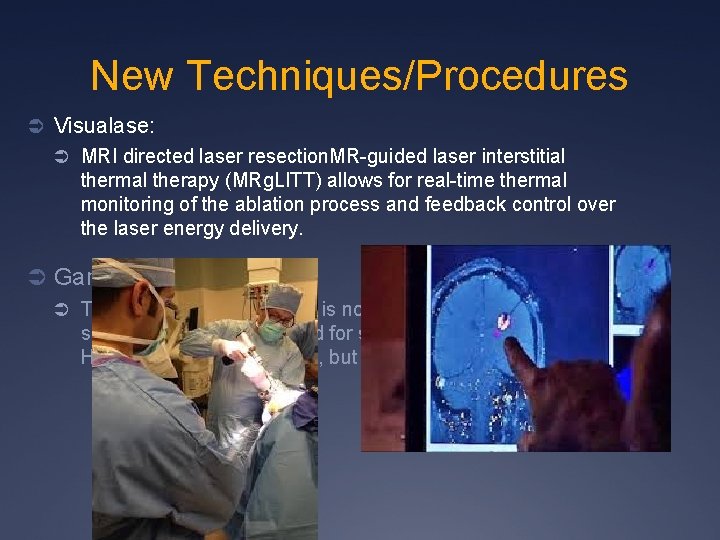 New Techniques/Procedures Ü Visualase: Ü MRI directed laser resection. MR-guided laser interstitial thermal therapy