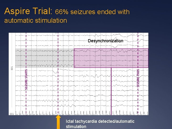 Aspire Trial: 66% seizures ended with automatic stimulation Desynchronization Ictal tachycardia detected/automatic stimulation 