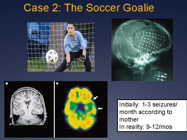 Case 2: The Soccer Goalie Initially: 1 -3 seizures/ month according to mother In