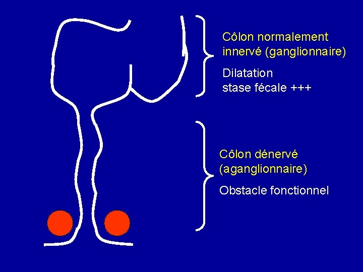 Côlon normalement innervé (ganglionnaire) Dilatation stase fécale +++ Côlon dénervé (aganglionnaire) Obstacle fonctionnel 