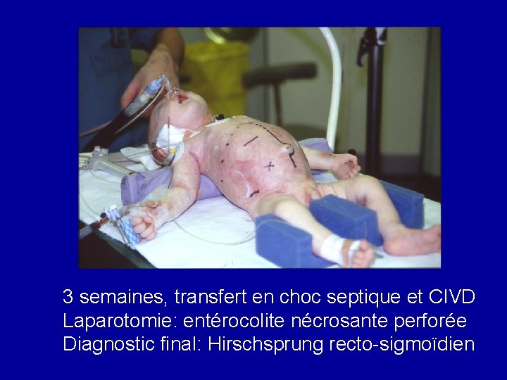 3 semaines, transfert en choc septique et CIVD Laparotomie: entérocolite nécrosante perforée Diagnostic final: