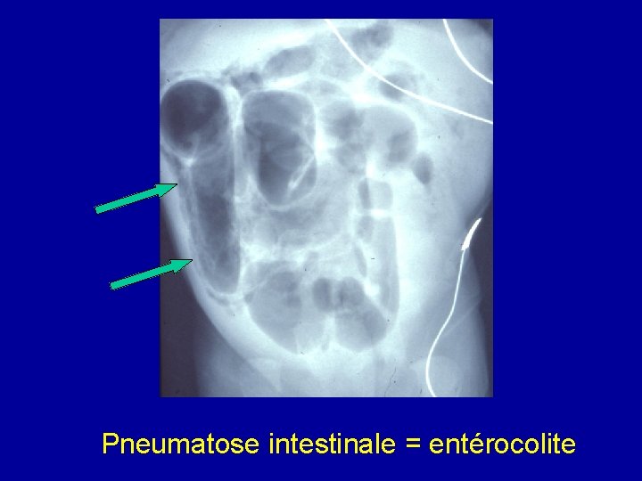 Pneumatose intestinale = entérocolite 