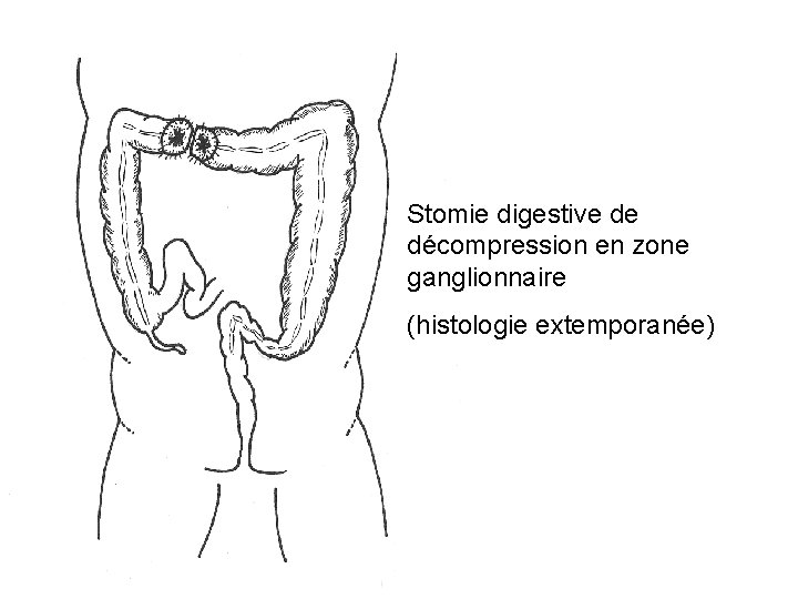 Stomie digestive de décompression en zone ganglionnaire (histologie extemporanée) 