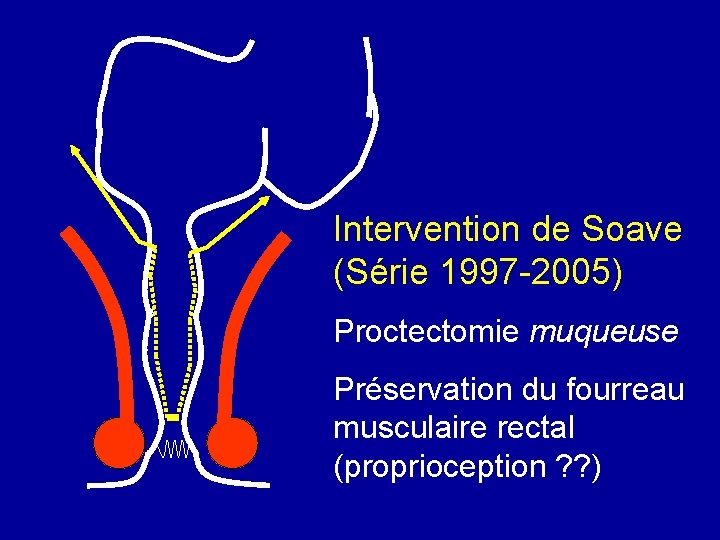 Intervention de Soave (Série 1997 -2005) Proctectomie muqueuse Préservation du fourreau musculaire rectal (proprioception
