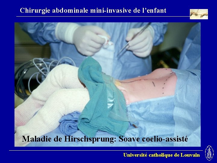 Chirurgie abdominale mini-invasive de l’enfant Maladie de Hirschsprung: Soave coelio-assisté Université catholique de Louvain
