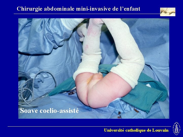 Chirurgie abdominale mini-invasive de l’enfant Soave coelio-assisté Université catholique de Louvain 