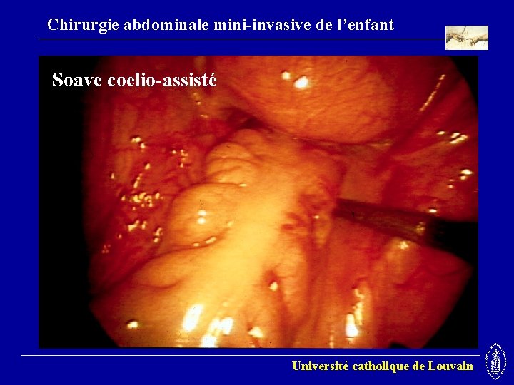 Chirurgie abdominale mini-invasive de l’enfant Soave coelio-assisté Université catholique de Louvain 