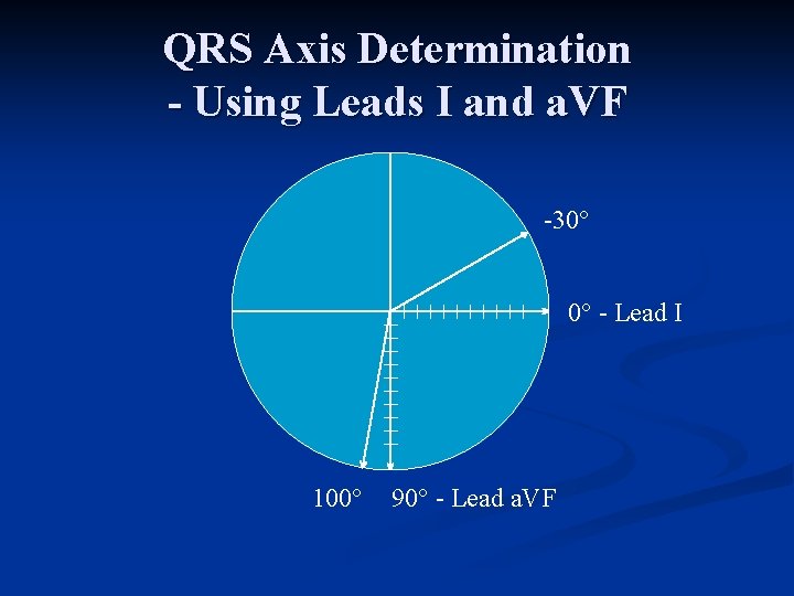 QRS Axis Determination - Using Leads I and a. VF 30° 0° Lead I