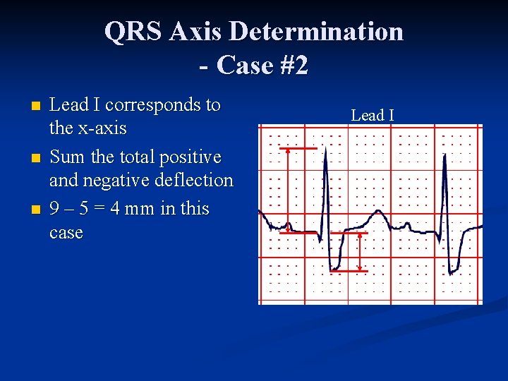 QRS Axis Determination - Case #2 n n n Lead I corresponds to the
