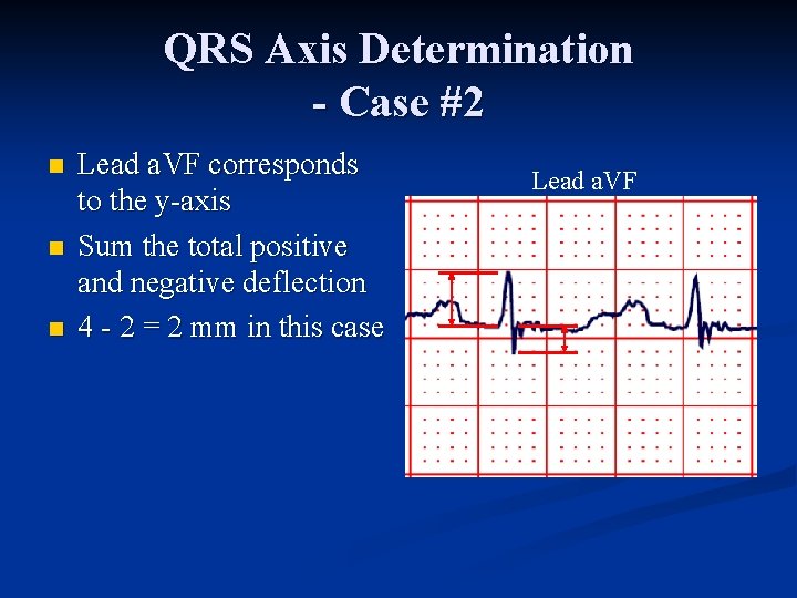 QRS Axis Determination - Case #2 n n n Lead a. VF corresponds to