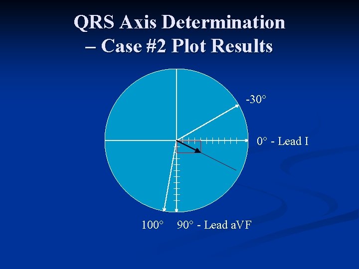 QRS Axis Determination – Case #2 Plot Results 30° 0° Lead I 100° 90°