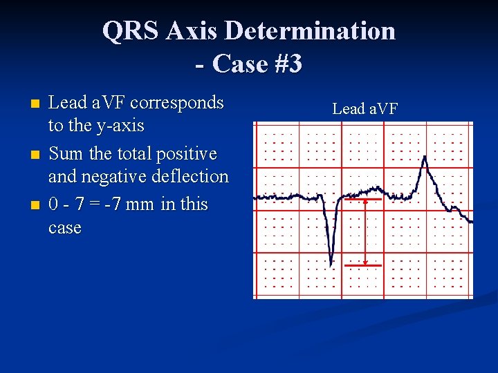 QRS Axis Determination - Case #3 n n n Lead a. VF corresponds to