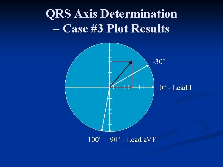 QRS Axis Determination – Case #3 Plot Results 30° 0° Lead I 100° 90°