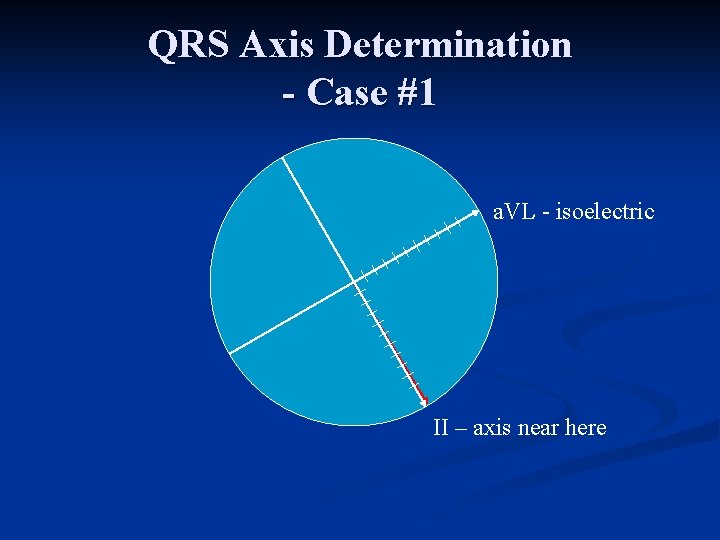 QRS Axis Determination - Case #1 a. VL isoelectric II – axis near here