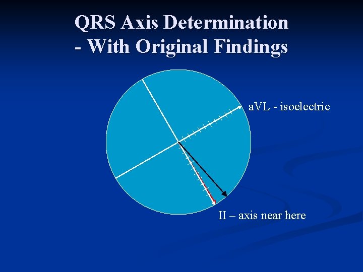 QRS Axis Determination - With Original Findings a. VL isoelectric II – axis near