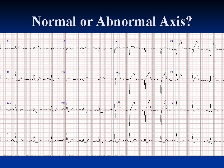 Normal or Abnormal Axis? 