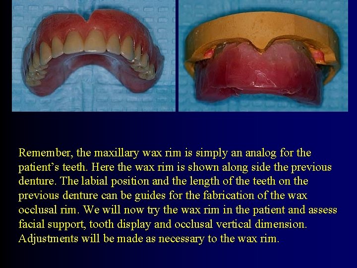 Remember, the maxillary wax rim is simply an analog for the patient’s teeth. Here