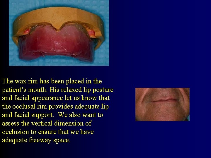 The wax rim has been placed in the patient’s mouth. His relaxed lip posture