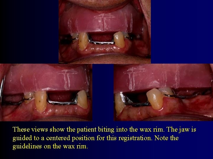 These views show the patient biting into the wax rim. The jaw is guided