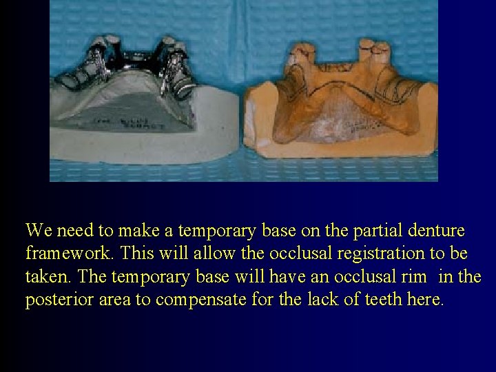We need to make a temporary base on the partial denture framework. This will