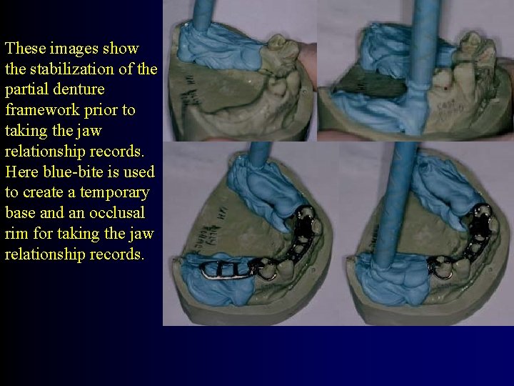 These images show the stabilization of the partial denture framework prior to taking the
