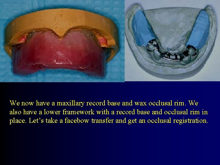 We now have a maxillary record base and wax occlusal rim. We also have