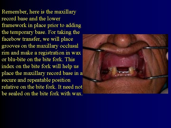 Remember, here is the maxillary record base and the lower framework in place prior