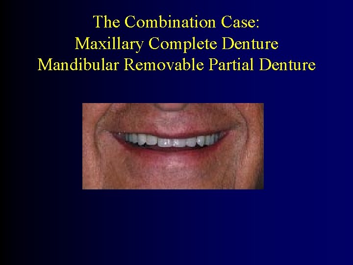 The Combination Case: Maxillary Complete Denture Mandibular Removable Partial Denture 