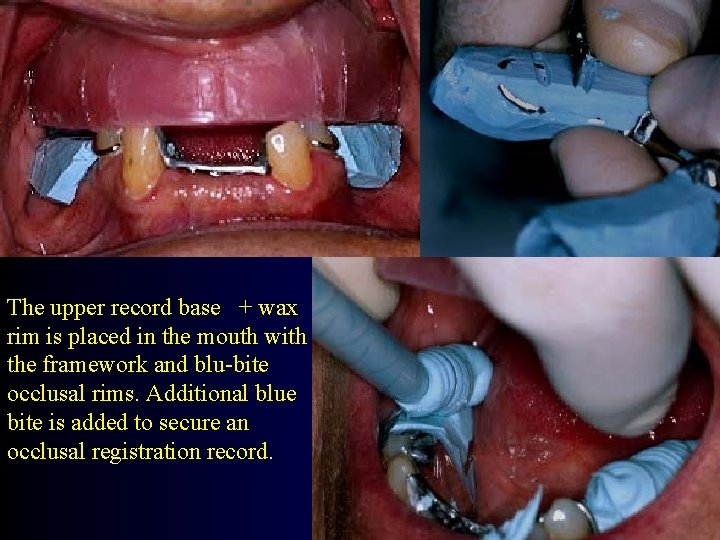 The upper record base + wax rim is placed in the mouth with the