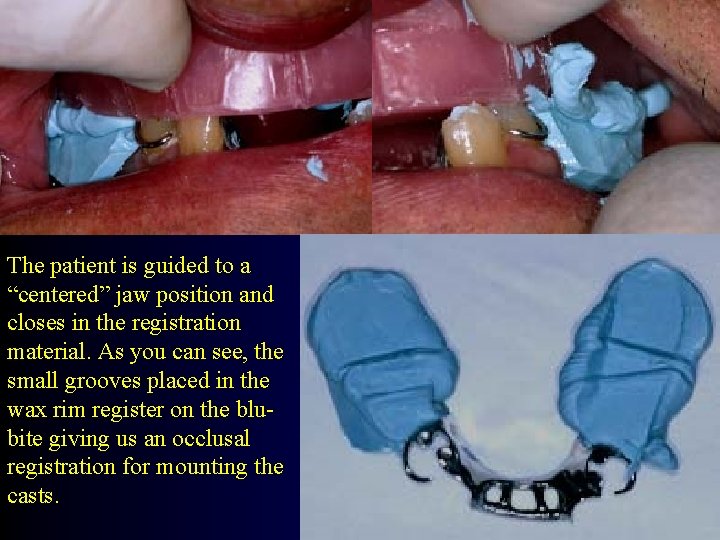 The patient is guided to a “centered” jaw position and closes in the registration