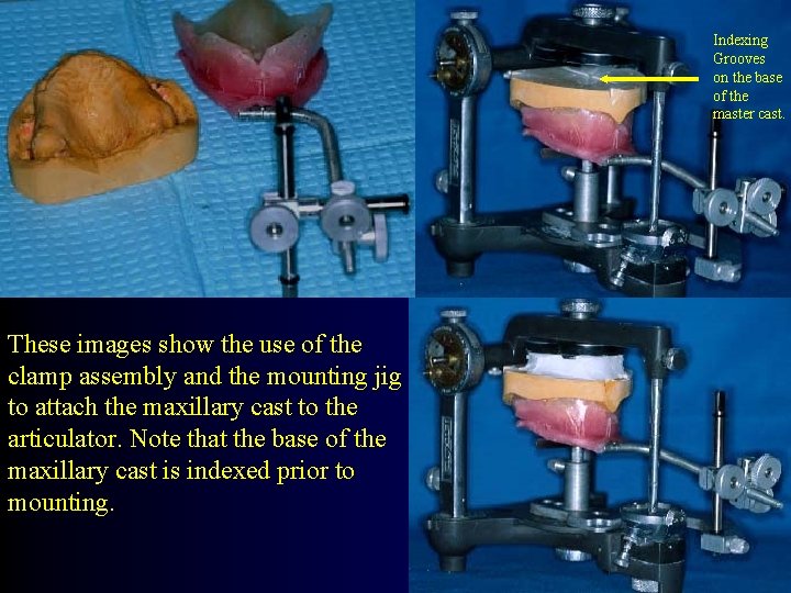 Indexing Grooves on the base of the master cast. These images show the use