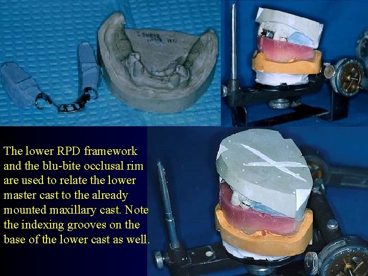 The lower RPD framework and the blu-bite occlusal rim are used to relate the