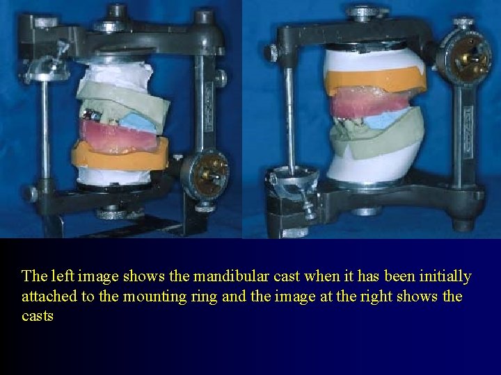 The left image shows the mandibular cast when it has been initially attached to