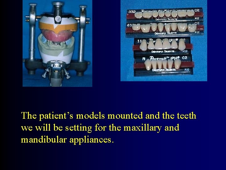 The patient’s models mounted and the teeth we will be setting for the maxillary