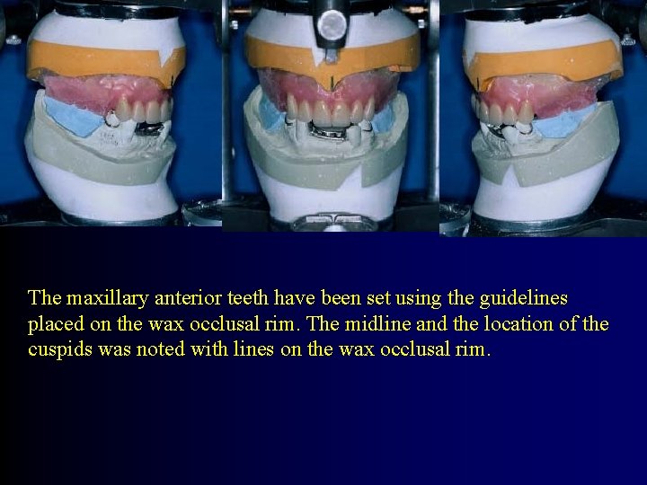 The maxillary anterior teeth have been set using the guidelines placed on the wax