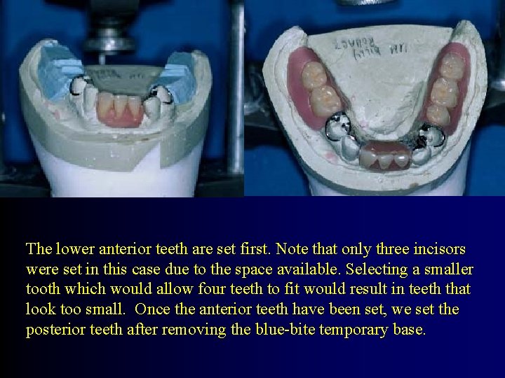 The lower anterior teeth are set first. Note that only three incisors were set