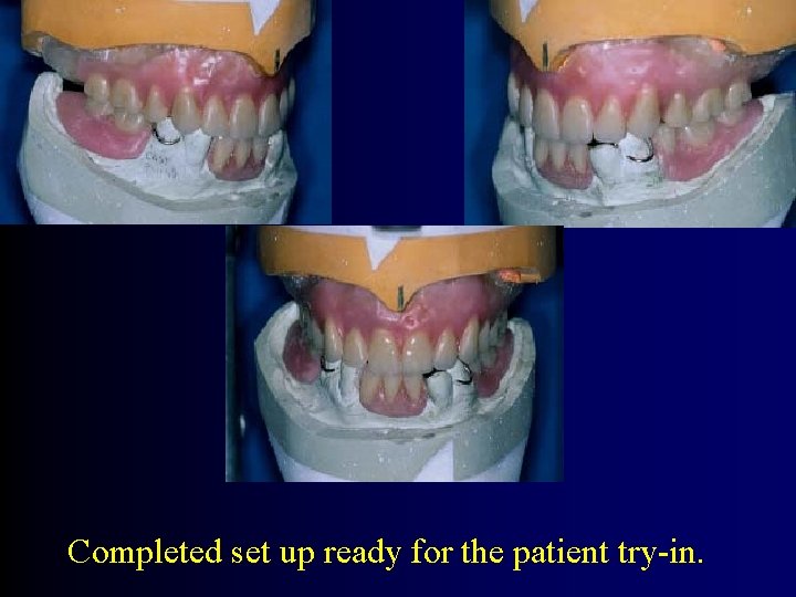 Completed set up ready for the patient try-in. 