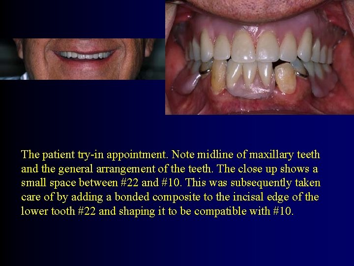 The patient try-in appointment. Note midline of maxillary teeth and the general arrangement of